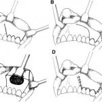 Maxillary sinusotomy, Caldwell-Luc method