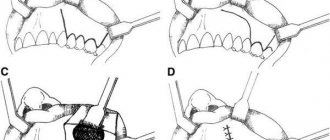 Maxillary sinusotomy, Caldwell-Luc method