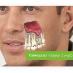 maxillary sinus