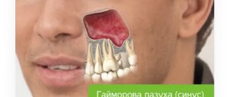 maxillary sinus