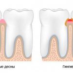 gingivitis