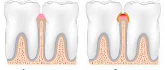 gingivitis