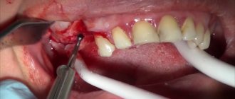 Surgical treatment of atrophy of the alveolar process of the upper jaw