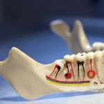 chronic form of granulating periodontitis