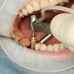 Implants Implantium - Dentistry Line Smiles