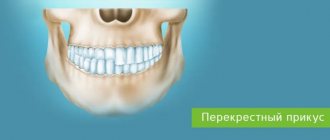 correction of mesial bite