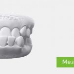 correction of mesial bite