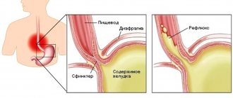 Image 1: GERD - Family Doctor Clinic