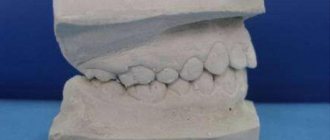 How to work with plaster in dentistry