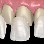 How to place veneers