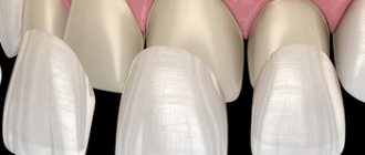 How to place veneers