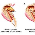 Как удаляют образование