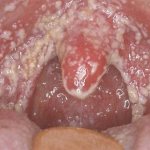 Candidiasis of the pharynx