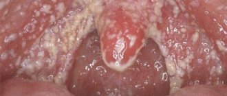 Candidiasis of the pharynx