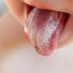 Candidiasis of the tongue in a child