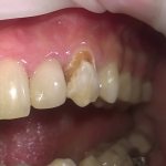 Caries on teeth