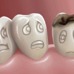 Dental caries