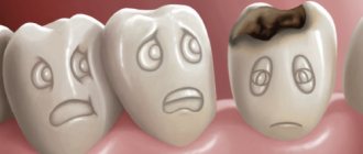 Dental caries