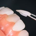 Ceramic veneers - what are they, service life, advantages