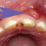 cyst in a child&#39;s mouth