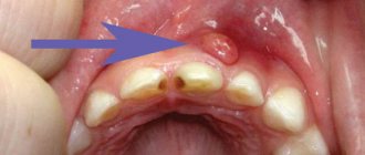 cyst in a child&#39;s mouth