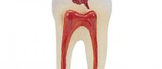 CLASSIFICATION OF CARIES ACCORDING TO BLACK