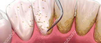 When is oral scaling performed?