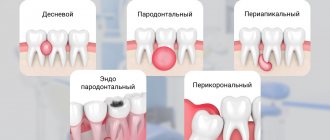 Collage of tooth abscess options