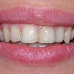 composite teeth whitening 1 - 1