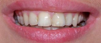 composite teeth whitening 1 - 1