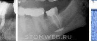 Composite materials in dentistry: chemical, light, fluid, micro-filled