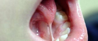 Short frenulum of the tongue in a child