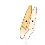 Corpus movement of teeth