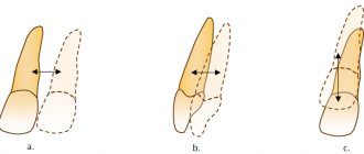 Corpus movement of teeth