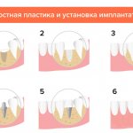 Костная пластика и установка имплантата в картинках