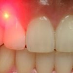 Laser teeth cleaning