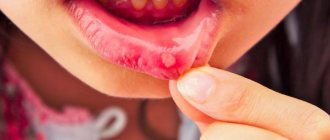 Treatment of herpetic stomatitis at the Family Dentist