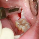 Treatment of pericoronitis of the wisdom tooth in the lower jaw