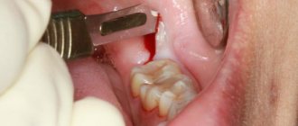 Treatment of pericoronitis of the wisdom tooth in the lower jaw