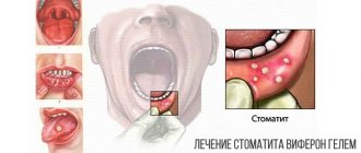 Treatment of stomatitis with Viferon