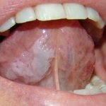 Oral leukoplakia