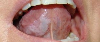 Oral leukoplakia