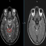 Lipoma of the quadrigeminal cistern on MRI