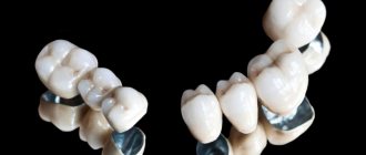 Metal-ceramic crowns on teeth