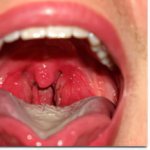 Tonsils