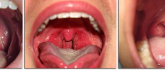 Tonsils