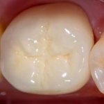 The molars of the posterior zone of the dentofacial apparatus are subjected to strong mechanical and chemical stress when chewing food.