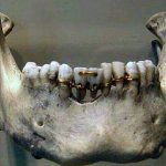 bridge with donor teeth