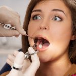 Is it possible to put braces on crowns, implants, fillings?