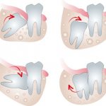 Is it possible to remove wisdom teeth when installing braces?